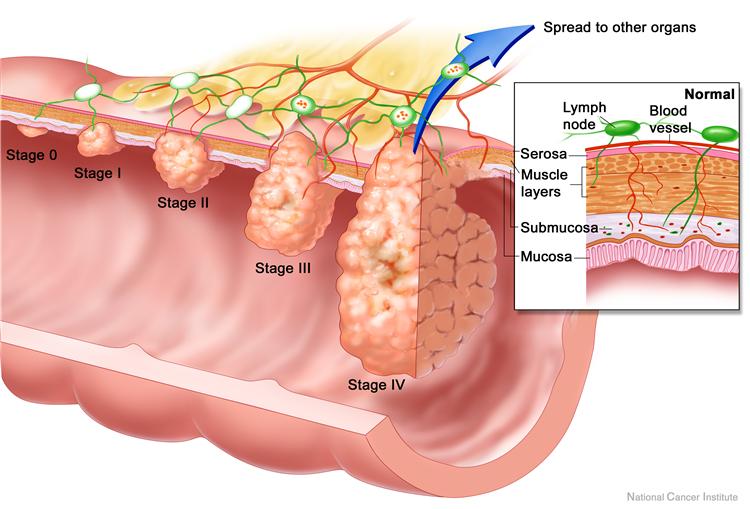 colon-cancer